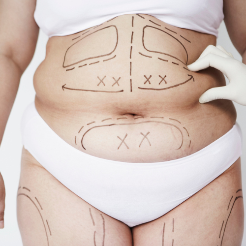 Liposuction