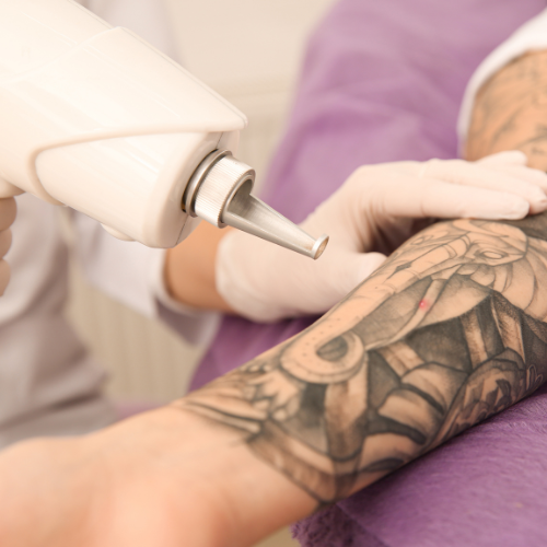 Tattoo removal