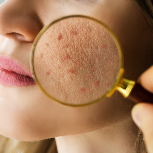Dermatology